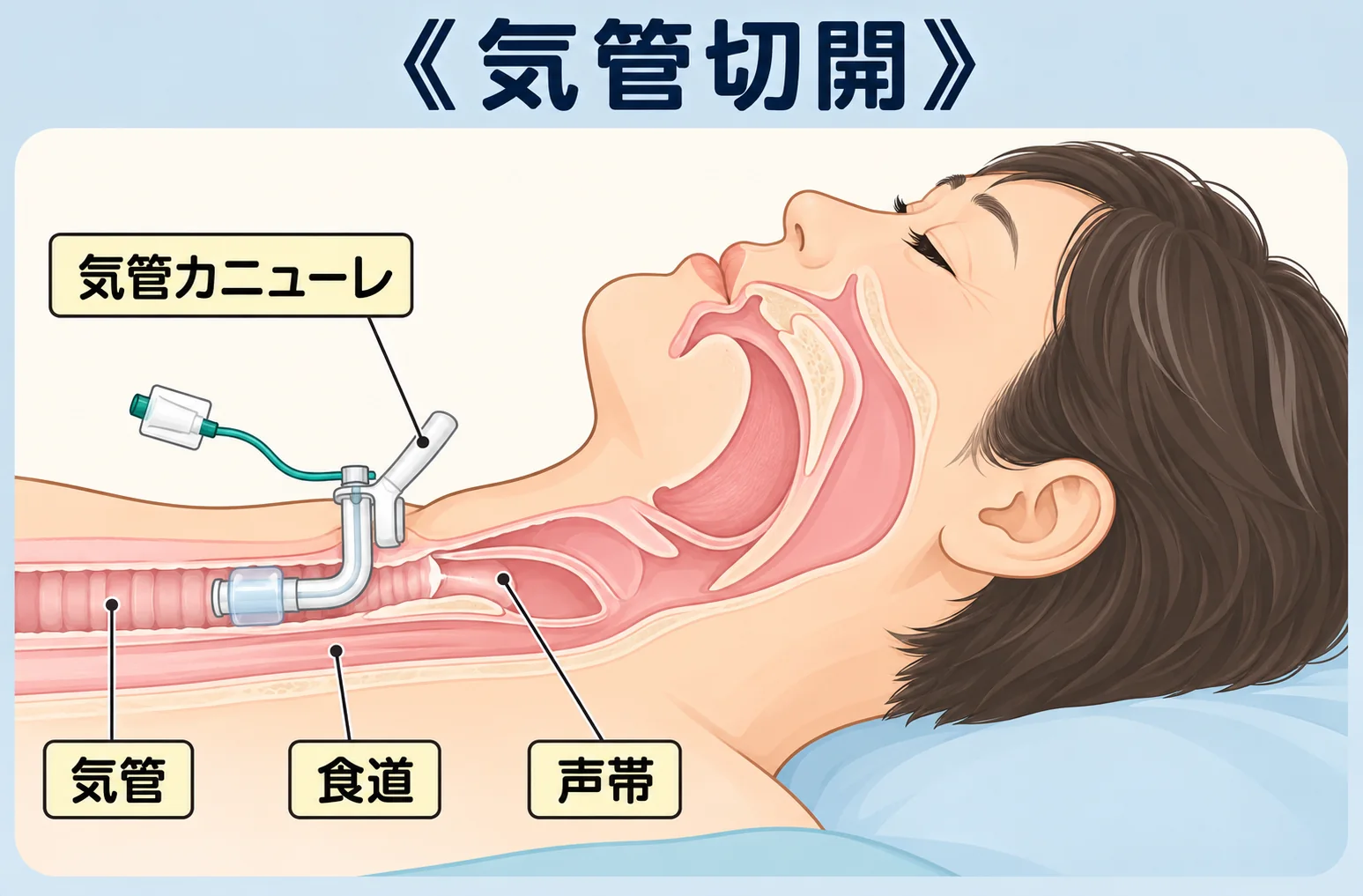 気管切開の位置を示す断面イラスト。気管カニューレ・気管・食道・声帯の位置関係